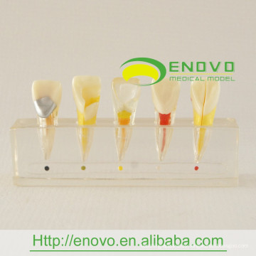 EN-M6 Best Price Dental Pulp Disease Clinical Model from Manufacturer Directly
